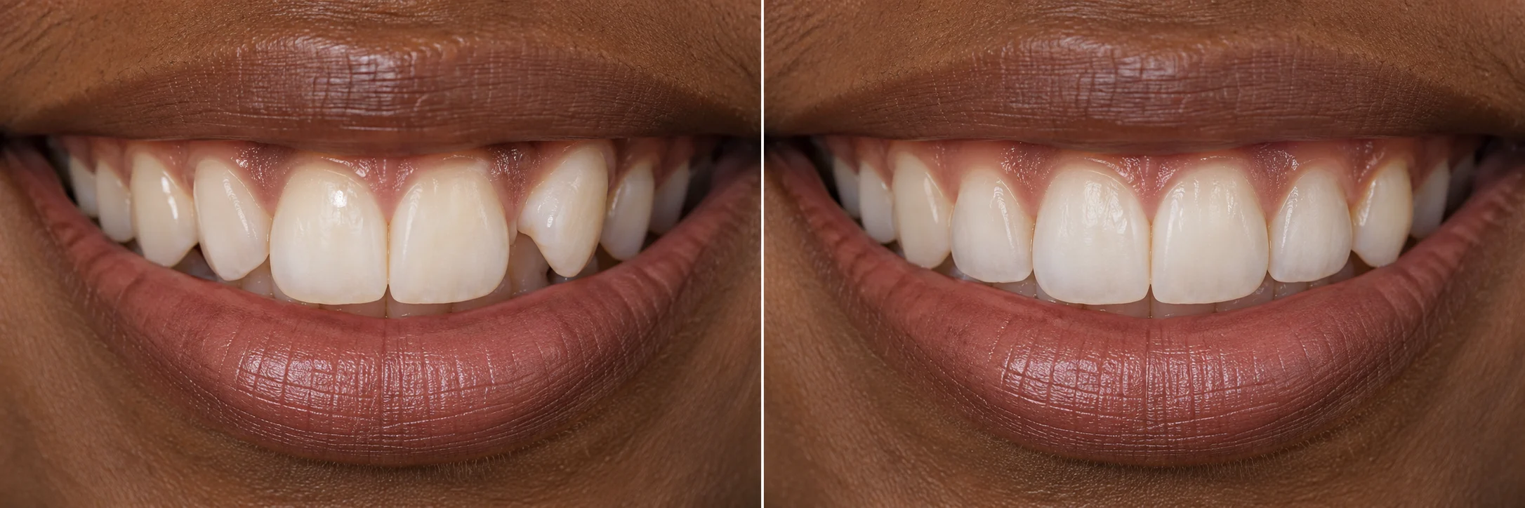 The same illustrative smile with the front teeth aligned