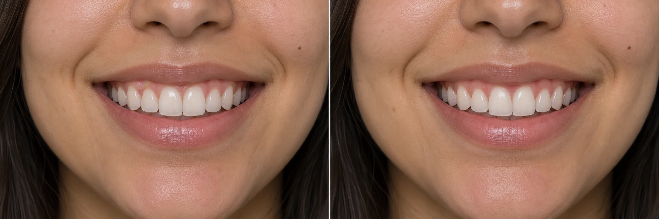 The same illustrative smile with a more even gumline