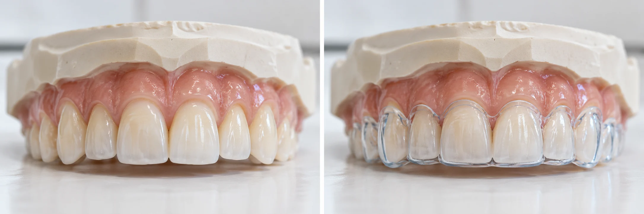 The same dental model with a custom clear guard fitted