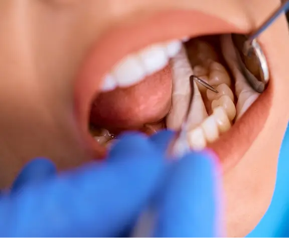 Dental Fillings