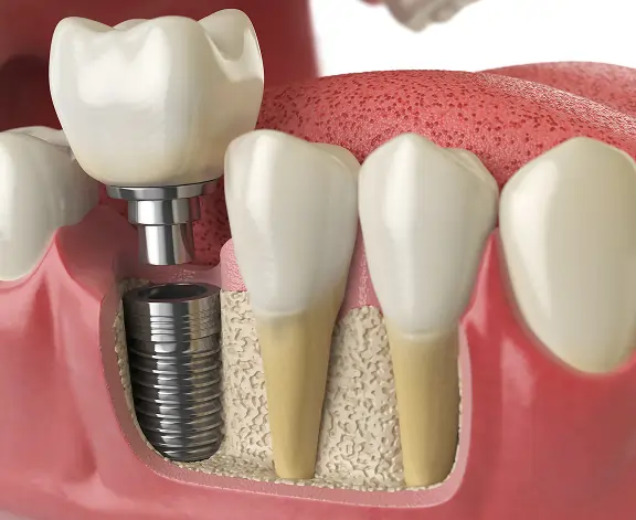 Dental Implants