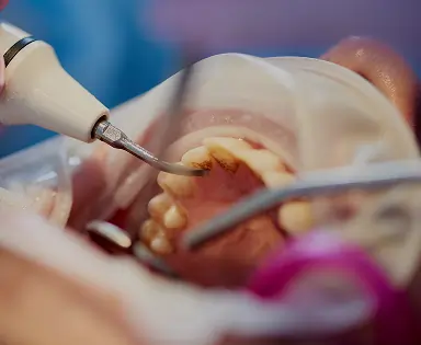 Scaling and Root Planing