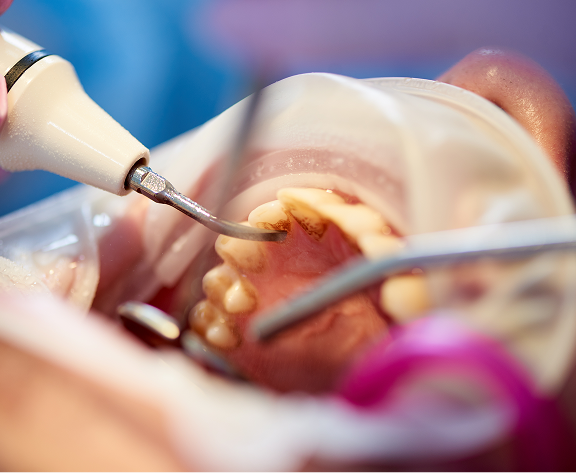 Scaling and Root Planing