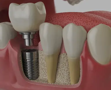 Dental Implants