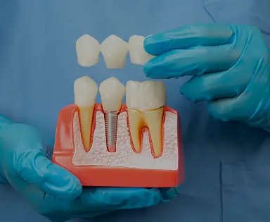 Dental Bridges