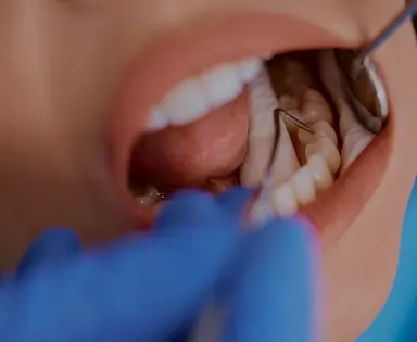 Dental Fillings
