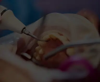 Scaling and Root Planing