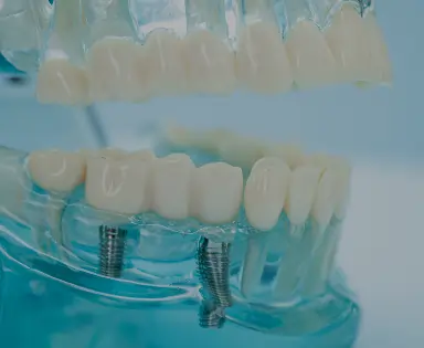 Implant Supported Dentures