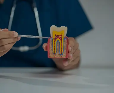 Root Canal