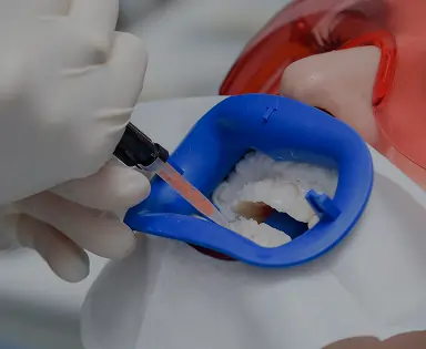 Dental Sealants