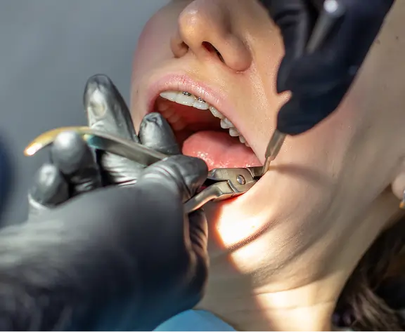 Tooth Extractions