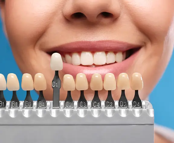 Dental Veneers