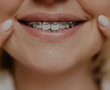 Metal Braces