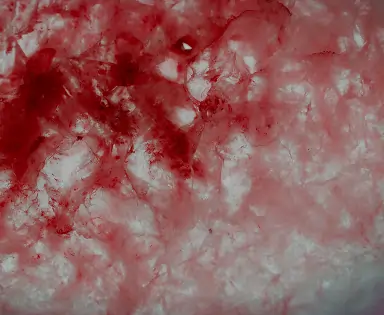 Connective Tissue Graft