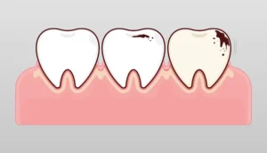Broken Tooth extraction